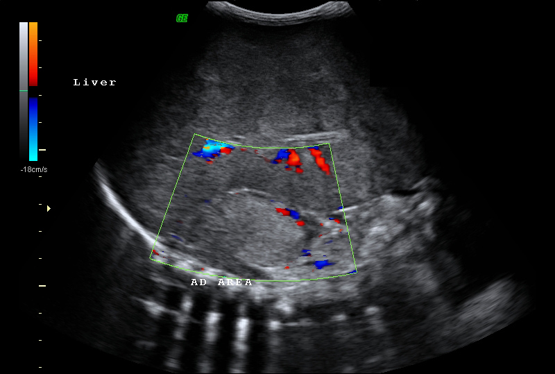 File:Neonatal neuroblastoma (Radiopaedia 9564-10221 A 4).jpg