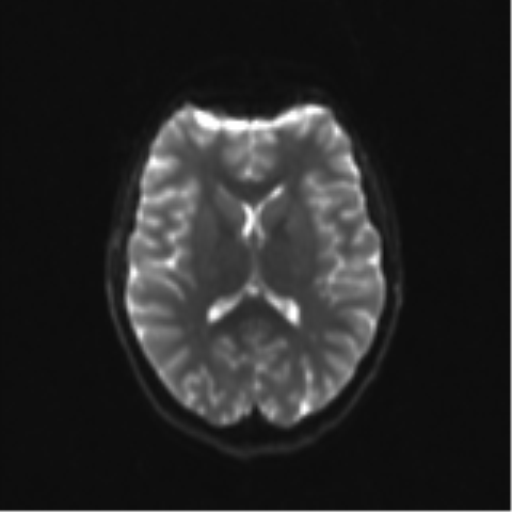 Neurenteric cyst (Radiopaedia 58641-65837 Axial DWI 21).png