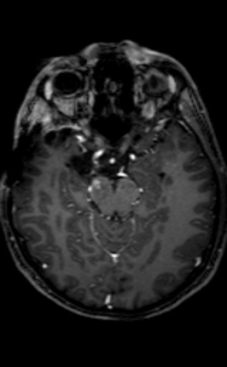 Neuro-Behçet disease (Radiopaedia 90112-107294 Axial T1 C+ 147).jpg
