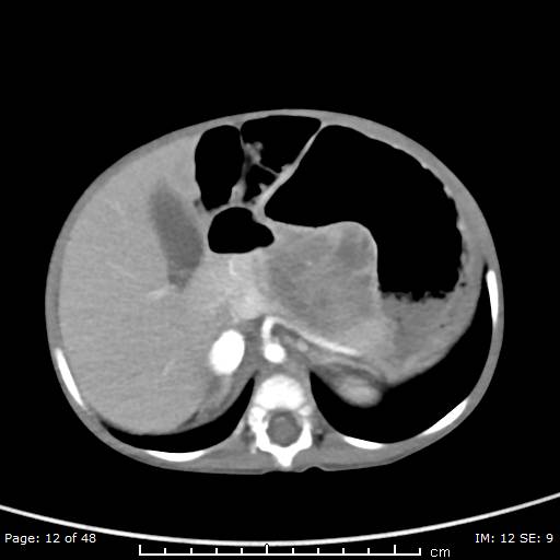 File:Neuroblastoma (Radiopaedia 41472-44355 A 12).jpg