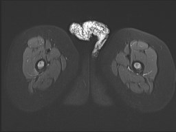 File:Neuroblastoma with bone metastases (Radiopaedia 67080-76414 Axial STIR 34).jpg