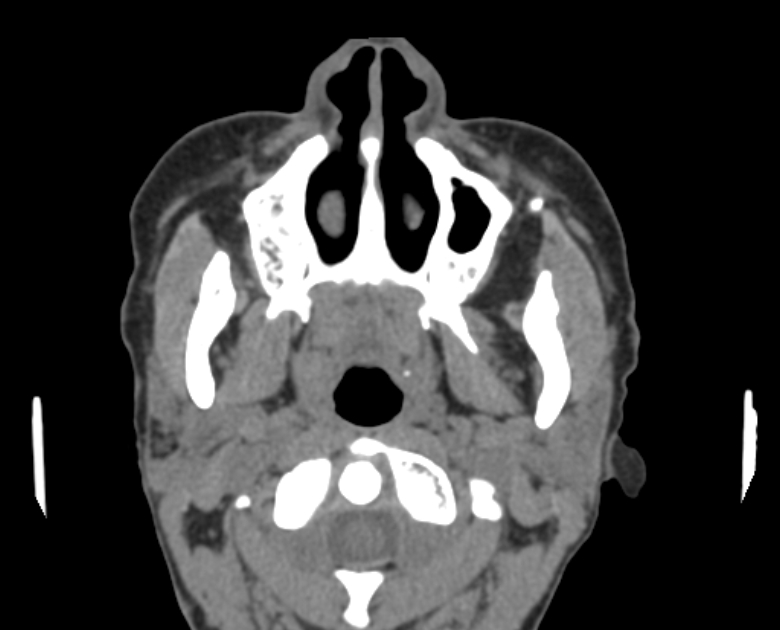 Neurofibromatosis type 1- orbital manifestations (Radiopaedia 49391-54511 Axial non-contrast 14).jpg