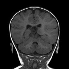File:Neurofibromatosis type 1 (Radiopaedia 30089-30671 Coronal T1 19).jpg
