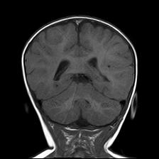 File:Neurofibromatosis type 1 (Radiopaedia 30089-30671 Coronal T1 20).jpg