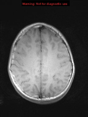 File:Neurofibromatosis type 1 with optic nerve glioma (Radiopaedia 16288-15965 Axial T1 7).jpg