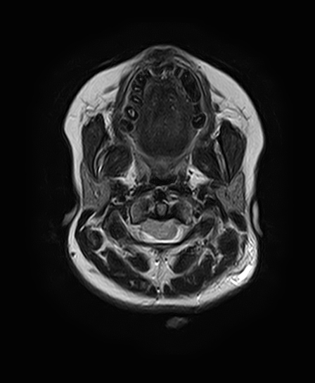 File:Neurofibromatosis type 2 (Radiopaedia 66211-75401 Axial T2 5).jpg