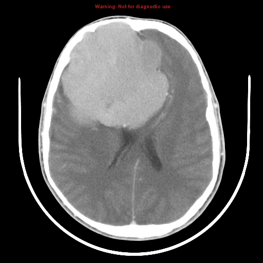 File:Neurofibromatosis type 2 (Radiopaedia 8953-9732 C 21).jpg
