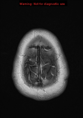 File:Neuroglial cyst (Radiopaedia 10713-11184 Axial T1 C+ 2).jpg