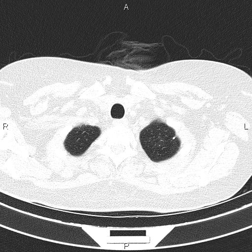 Non-specific interstitial pneumonia (Radiopaedia 83185-97567 Axial lung window 11).jpg