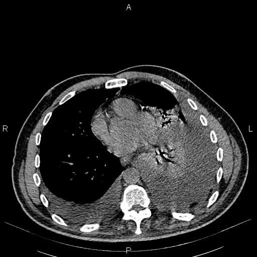 File:Non Hodgkin lymphoma in a patient with ankylosing spondylitis (Radiopaedia 84323-99621 Axial non-contrast 19).jpg