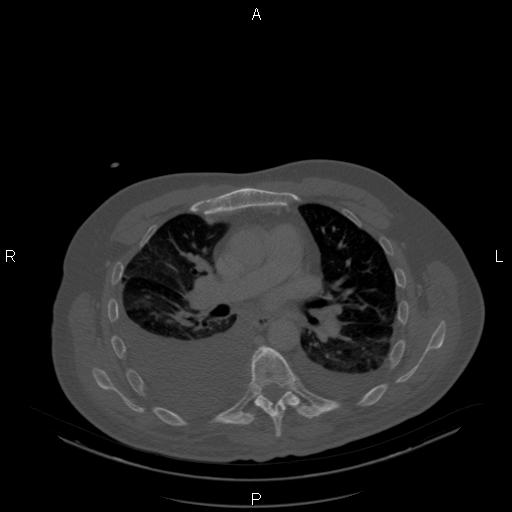 Non Hodgkin lymphoma in a patient with ankylosing spondylitis (Radiopaedia 84323-99624 Axial bone window 14).jpg