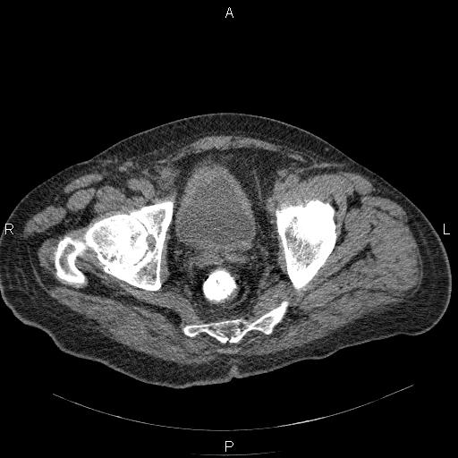 File:Non Hodgkin lymphoma in a patient with ankylosing spondylitis (Radiopaedia 84323-99624 Axial non-contrast 61).jpg