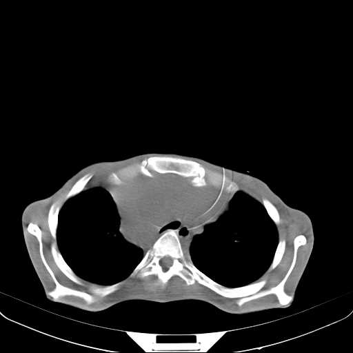 File:Non hodgkin lymphoma of the mediastinum (Radiopaedia 20814-20729 Axial non-contrast 9).jpg