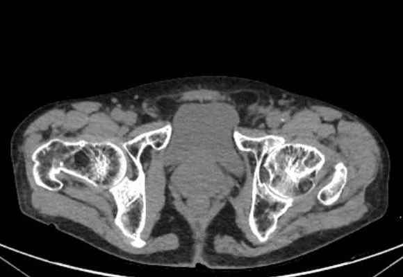 File:Nondisplaced incomplete intertrochanteric fracture (Radiopaedia 73736-84539 Axial soft tissue 62).jpg