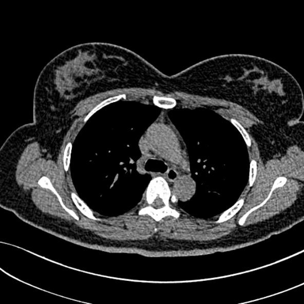 Normal CT chest- adult female (Radiopaedia 52522-58428 Axial non-contrast 47).jpg