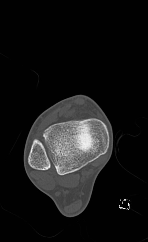 Normal CT of the ankle (Radiopaedia 47111-51658 Axial bone window 34).jpg