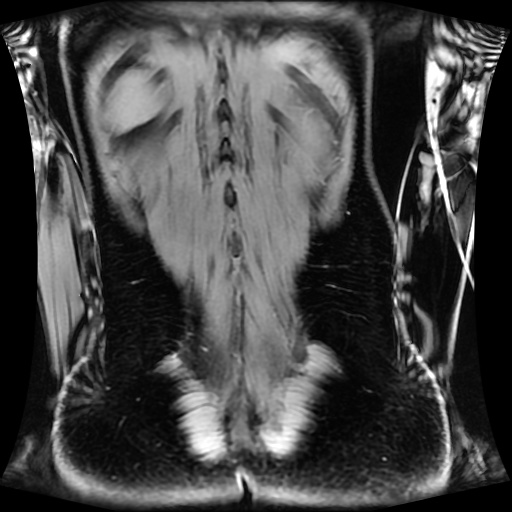 Normal MRI abdomen in pregnancy (Radiopaedia 88001-104541 M 119).jpg