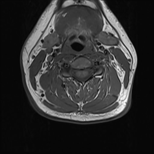 File:Normal MRI cervical spine (infection protocol) (Radiopaedia 53916-60039 Axial 24).png