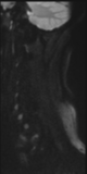 File:Normal MRI cervical spine (infection protocol) (Radiopaedia 53916-60039 Sagittal DWI 29).png