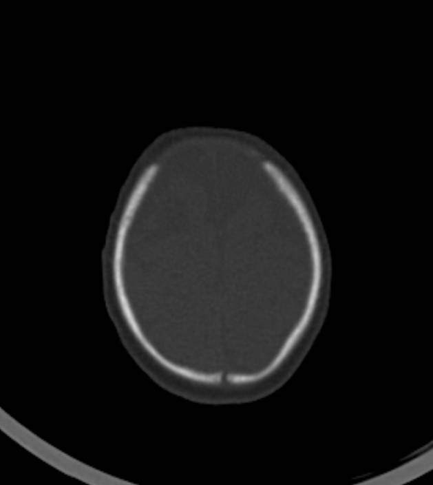 Normal brain CT - 2-month-old (Radiopaedia 53369-59350 Axial bone window 9).jpg