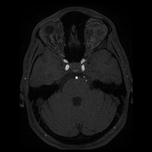 Normal brain MRA (Radiopaedia 41046-43793 Axial MRA 72).png