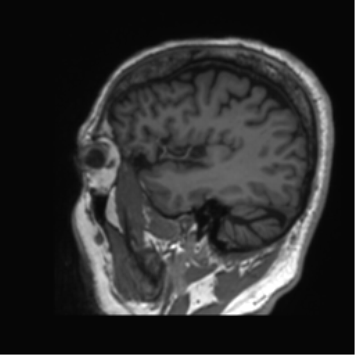 Normal brain MRI (non-focal epilepsy protocol) (Radiopaedia 53917-60040 Sagittal T1 11).png