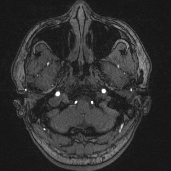 Normal brain MRI including MRA (Radiopaedia 48748-53763 Axial MRA 14).jpg
