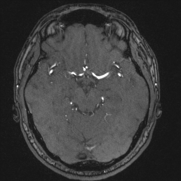 Normal brain MRI including MRA (Radiopaedia 48748-53763 Axial MRA 85).jpg