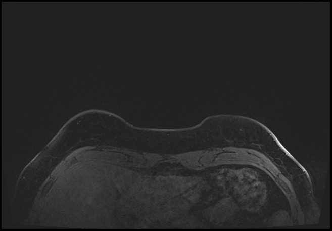 Normal breast MRI - dense breasts (Radiopaedia 80454-93850 C 9).jpg