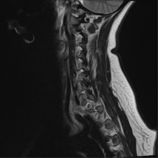 File:Normal cervical spine MRI (including Dixon) (Radiopaedia 42762-45925 Dixon- in-phase 2).png