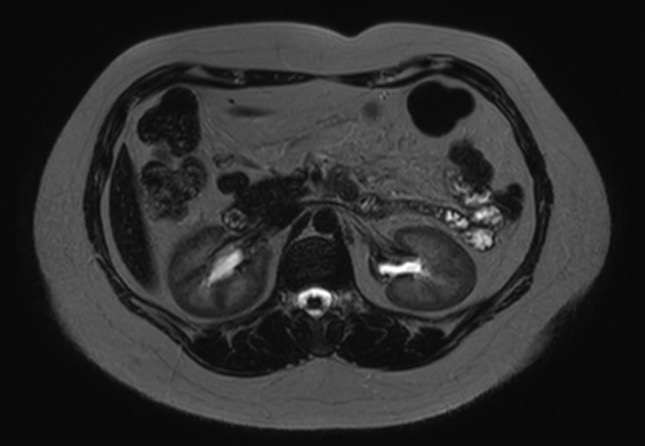 File:Normal liver MRI with Gadolinium (Radiopaedia 58913-66163 E 14).jpg