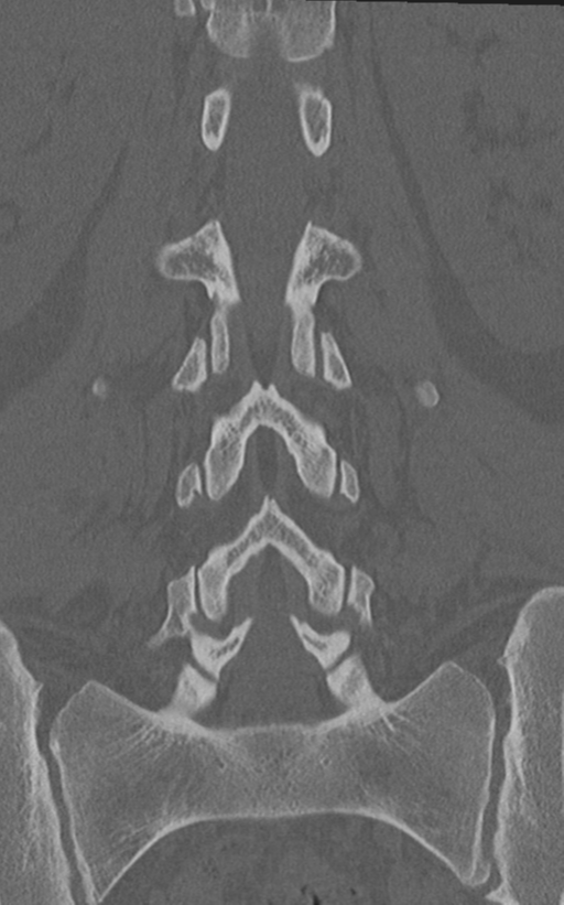 Normal lumbar spine CT (Radiopaedia 46533-50986 Coronal bone window 45).png