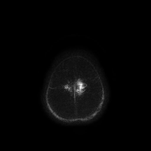 Normal noncontrast MR venography (Radiopaedia 87578-103957 Axial SWI 7).jpg