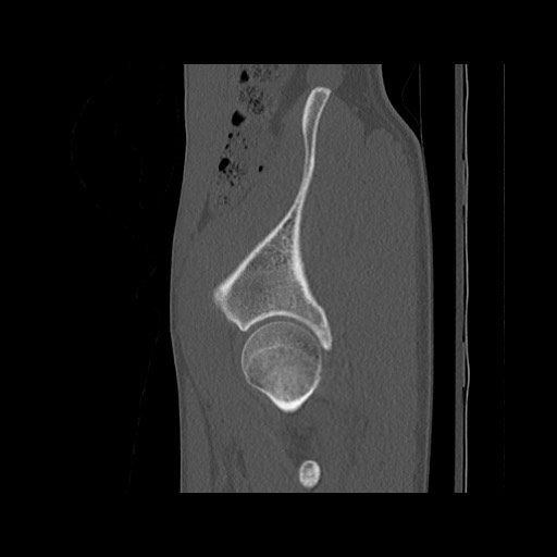 Normal pelvis (Radiopaedia 51473-57238 Sagittal bone window 31).jpg