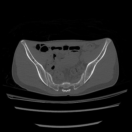 Normal pelvis CT (Radiopaedia 51471-57236 Axial bone window 42).jpg