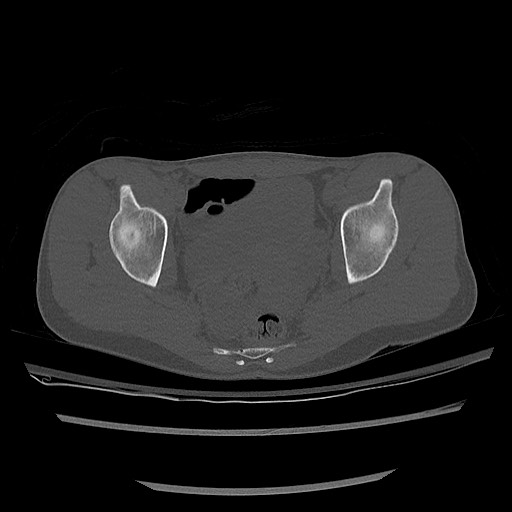 Normal pelvis CT (Radiopaedia 51471-57236 Axial bone window 62).jpg