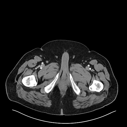 Obstructing sigmoid adenocarcinoma (Radiopaedia 58465-65619 A 175).jpg