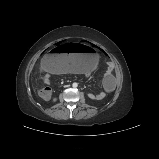 Obstructive distal colonic adenocarcinoma causing cecal perforation (Radiopaedia 86830-102989 A 99).jpg