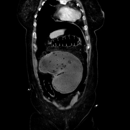 Obstructive distal colonic adenocarcinoma causing cecal perforation (Radiopaedia 86830-102989 C 58).jpg