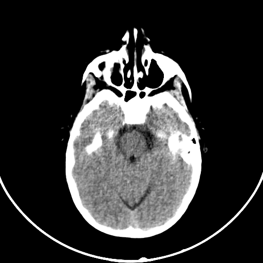 Occipital encephalocele (Radiopaedia 87339-103636 Axial non-contrast 29).jpg