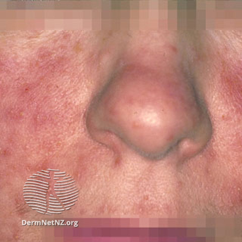 Rosacea (DermNet NZ acne-red-face-3608).jpg