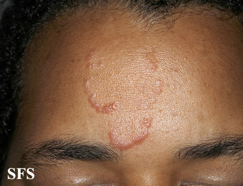 File:Sarcoidosis (Dermatology Atlas 20).jpg