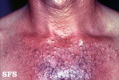 File:Syringoma (Dermatology Atlas 3).jpg