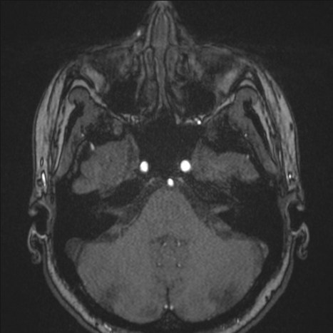 A1 segment hypoplasia (Radiopaedia 83365-97781 Axial TOF MRA 34).jpg