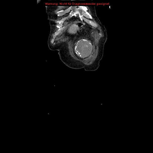 Abdominal aortic aneurysm- extremely large, ruptured (Radiopaedia 19882-19921 Coronal C+ arterial phase 8).jpg