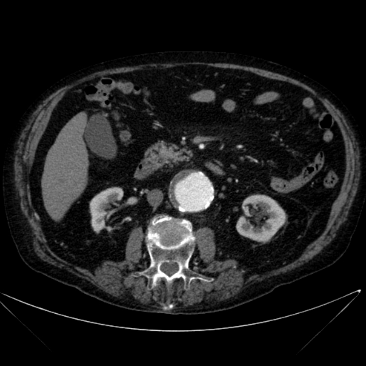 Abdominal aortic aneurysm (Radiopaedia 25855-26001 Axial C+ arterial phase 59).jpg