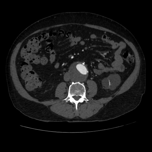 File:Abdominal aortic aneurysm (Radiopaedia 57318-64259 Axial C+ arterial phase 41).jpg