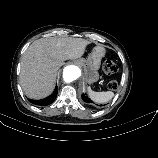 Abdominal aortic aneurysm (Radiopaedia 67117-76452 Axial C+ arterial phase 23).jpg