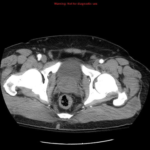 File:Abdominal aortic aneurysm (Radiopaedia 8190-9038 Axial C+ arterial phase 81).jpg