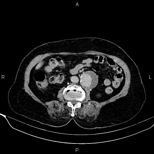 Abdominal aortic aneurysm (Radiopaedia 85063-100606 Axial C+ delayed 59).jpg